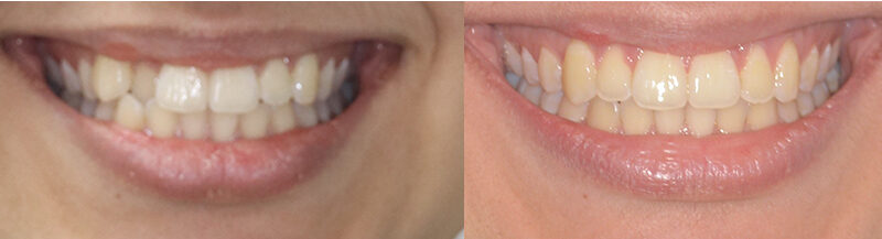 ¿Vale la pena la ortodoncia en adultos?