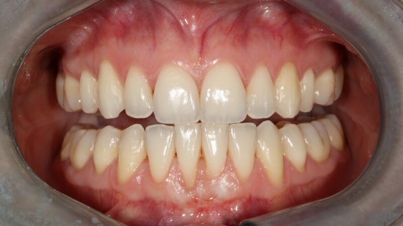 blanqueamiento dental