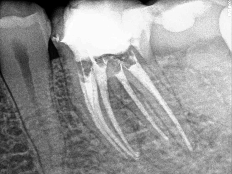 endodoncia multirradicular