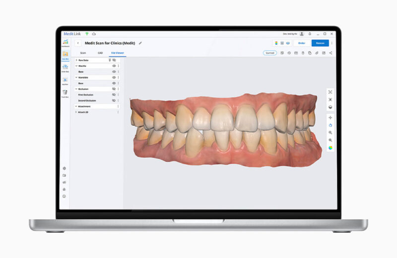 Llega la tecnología del escaner intraoral en 3 dimensiones a la Clínica Dental Cortés Martinicorena