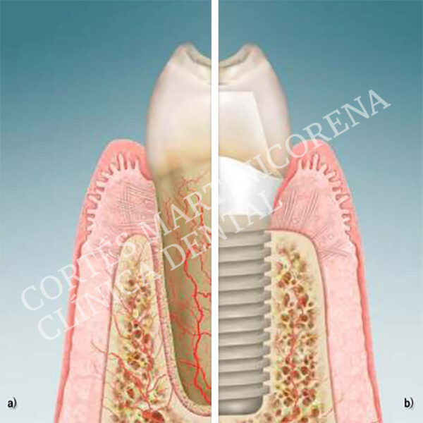 Periimplantitis