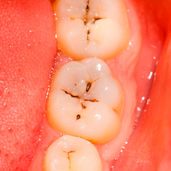 Caries dental